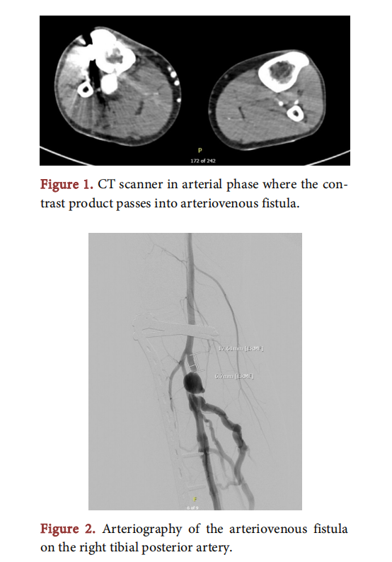 case-report-of-a-chronic-wound-due-to-venous-insufficiency-following-a